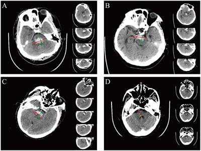 Prognostic models for survival and consciousness in patients with primary brainstem hemorrhage